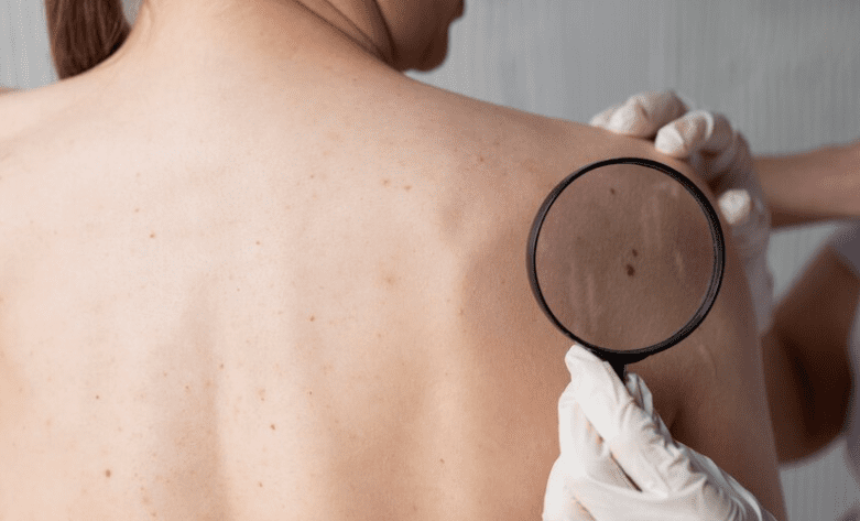 Como empieza el cancer de piel