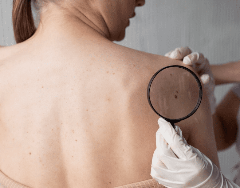 Como empieza el cancer de piel