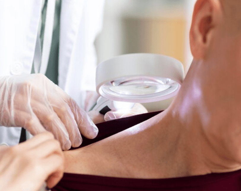 Tipos de cancer de piel