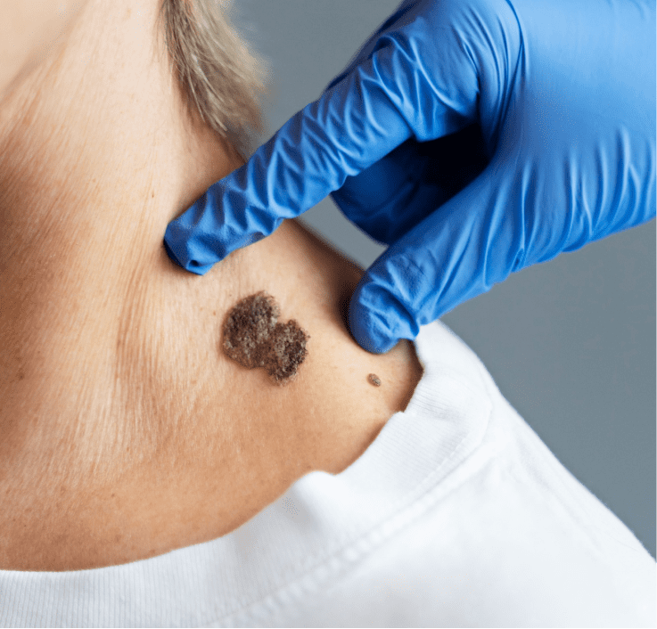 Melanoma